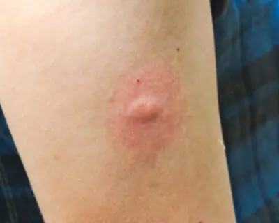 mosquito bite